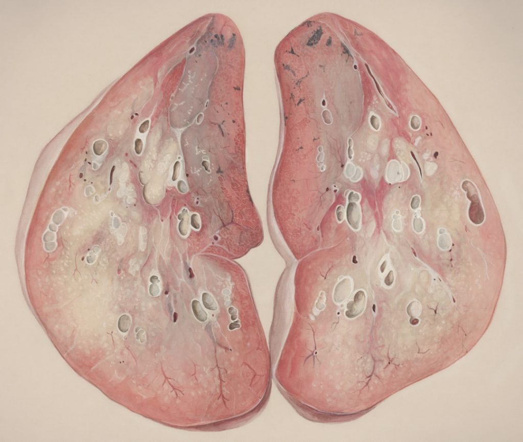 Photo asthma clinical study