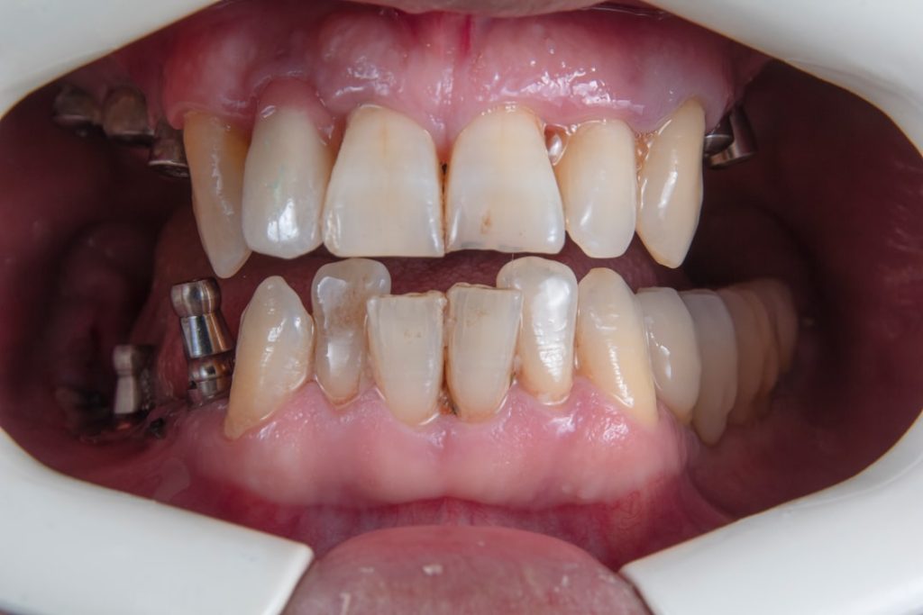 Photo dental implant clinical trial